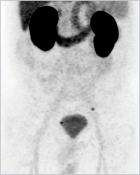 MIPS showing score of 1: Urinary activity visible but distinction between urine and disease possible