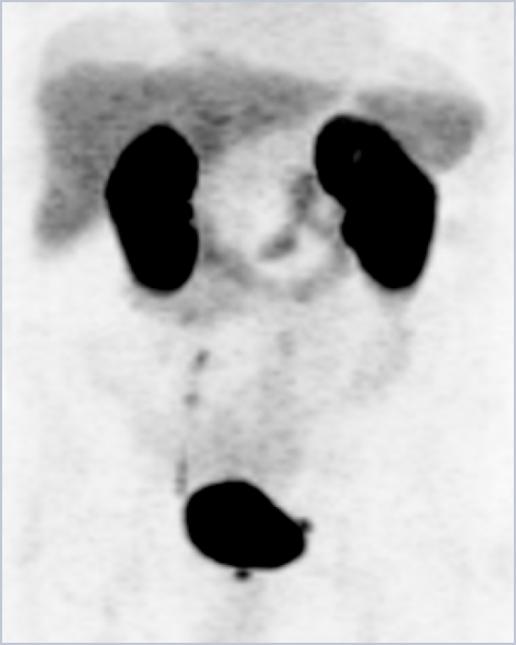 MIPS showing score of 2: Assessment inhibited by urinary activity