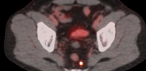 POSLUMA PET scan showing uptake in the internal iliac lymph node