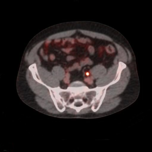 LEFT COMMON ILIAC LN image