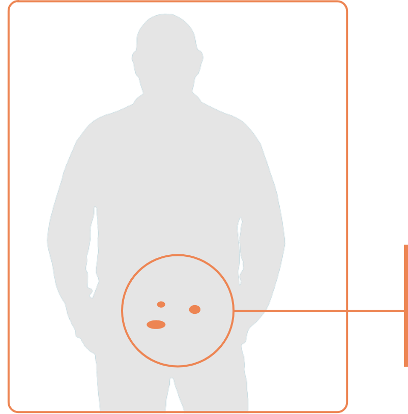 Silhouette of a man with orange ovals representing prostate cancer identified through an imaging scan