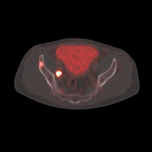 ILIAC BONE image