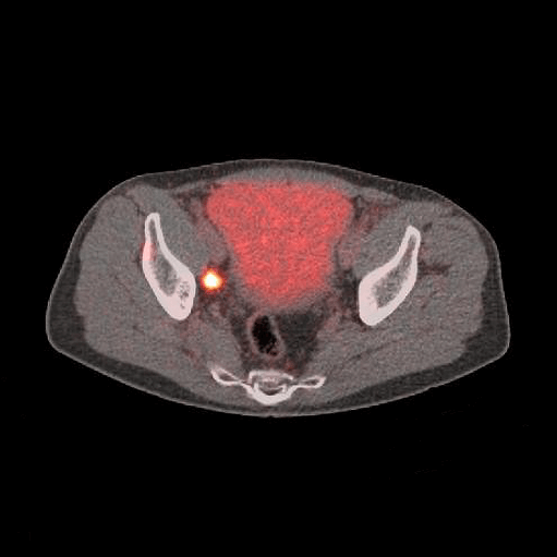 INTERNAL ILIAC LN image