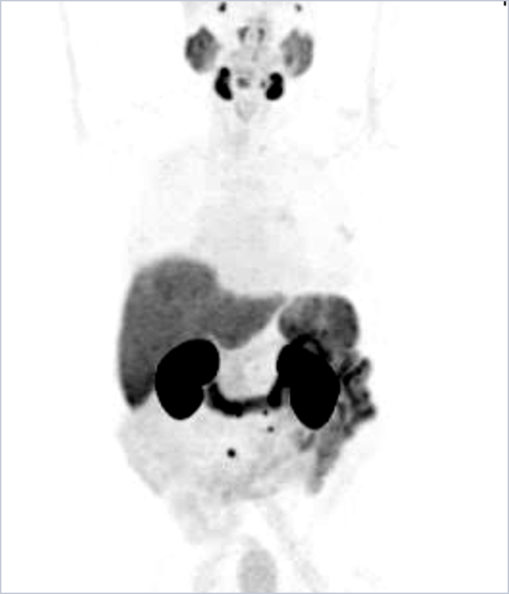 MIPS from a POSLUMA PET scan for patient 1 case study