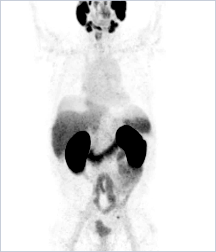 MIPS from a POSLUMA PET scan for patient 2 case study