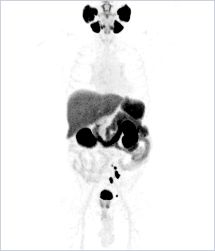 MIPS from a POSLUMA PET scan for patient 1 case study