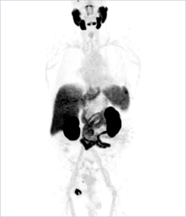 MIPS from a POSLUMA PET scan for patient 2 case study