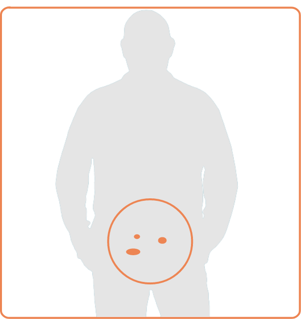 Silhouette of a man with orange ovals representing prostate cancer identified through an imaging scan