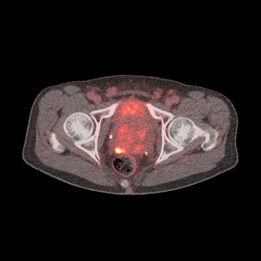 PROSTATE scan image